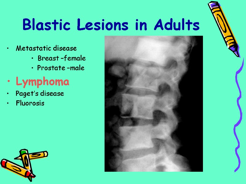 Metastatic disease Breast –female Prostate –male Lymphoma Paget’s disease Fluorosis Blastic Lesions in Adults